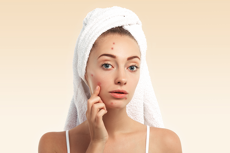 Acne Treatment Effective